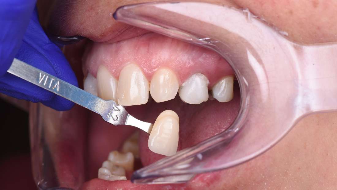 How to find a good cosmetic dentist in Harford CT Cosmetic Dentistry Hartford CT