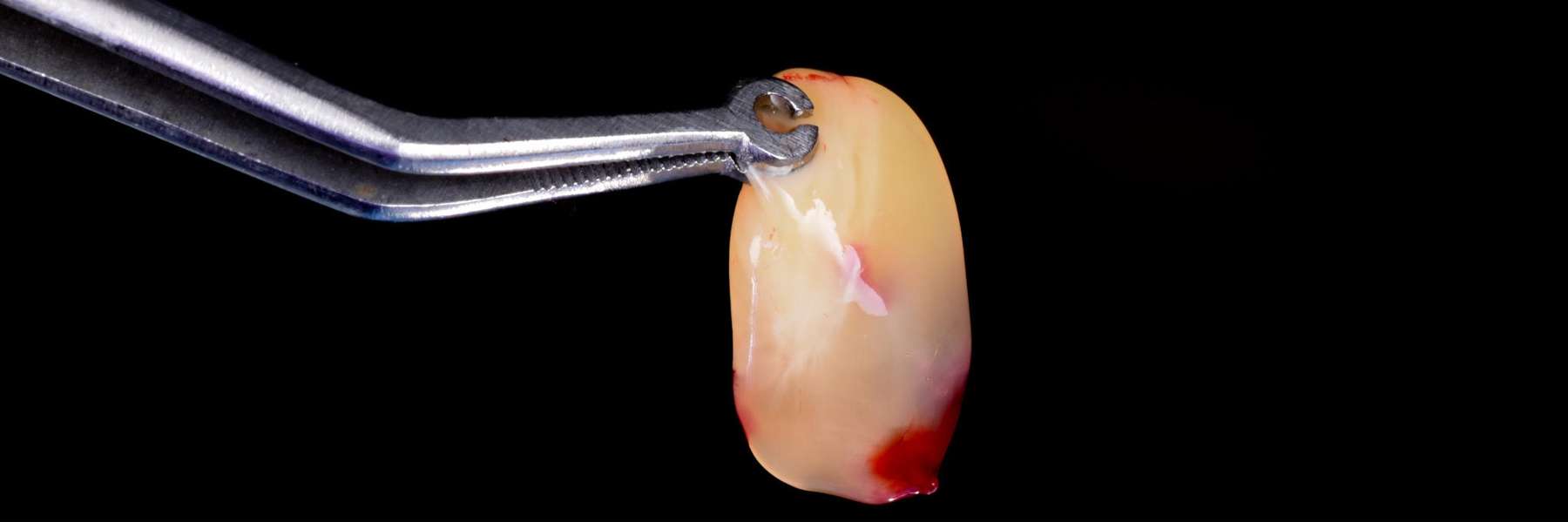 Platelet Rich Plasma | Dentist