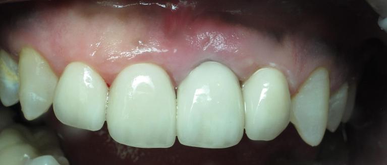 anterior-implant-veneer-After-Image