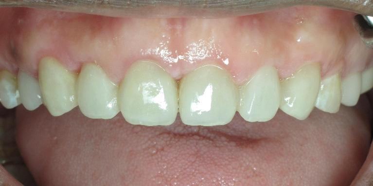 esthetic-gum-surgery-bridge-After-Image