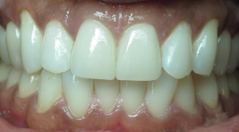 Veneer-After-Image