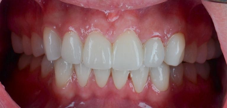 Smile-Makeover-Crowns-After-Image