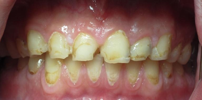 Smile-Makeover-Crowns-Before-Image