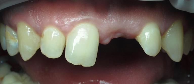 anterior-implant-veneer-Before-Image