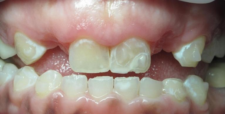 esthetic-gum-surgery-bridge-Before-Image