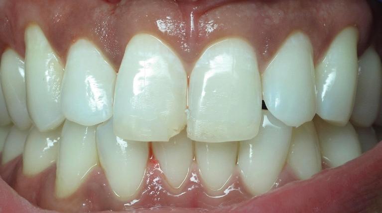Veneer-Before-Image